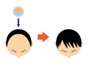 毛髪再生医療の費用は 髪の再生 老化防止も Ips細胞を大量生産できる新技術で約1億円の作製費用も低コストに 発毛 育毛 薄毛のお悩みなら毛髪再生 治療ナビ